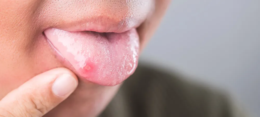 Dil yarası neden olur? Dil yarası neyin belirtisi olabilir?