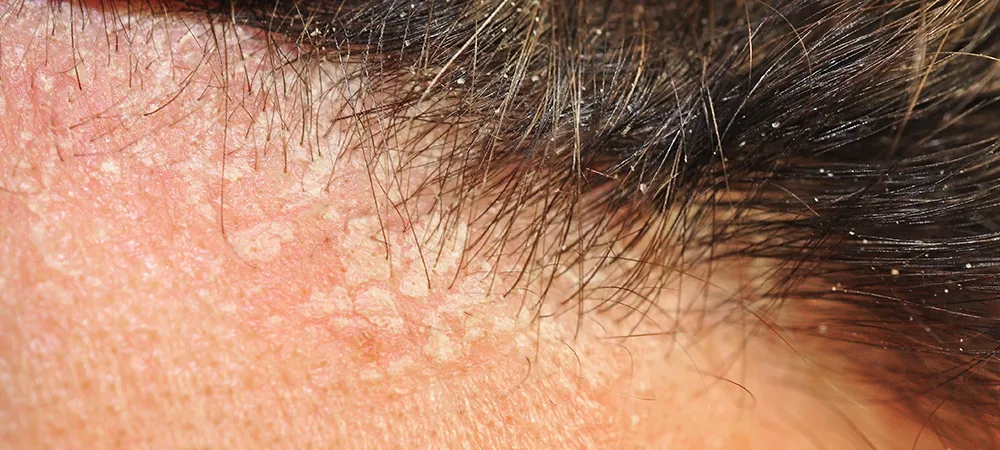 Saç derisinde kabuklanma nasıl geçer? Kabuk tutan saça ne iyi gelir?