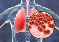 Zatürre nedir? Zatürre neden olur?